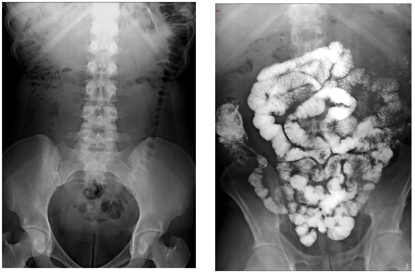 Pathologie digestive - grêle et colon, imagerie et pathologie