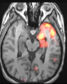 Imagerie de l’épilepsie