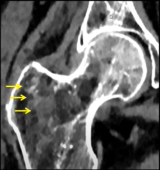 Scanner double énergie et pathologies osseuses des tissus mous