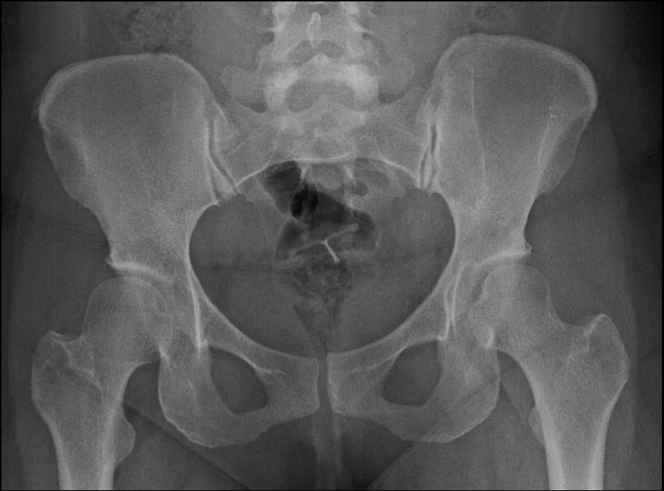 Imagerie de la hanche :  variantes et anomalies fréquemment asymptomatiques