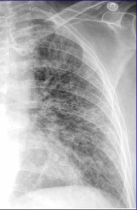 Fibrose pulmonaire : approche diagnostique et cas cliniques