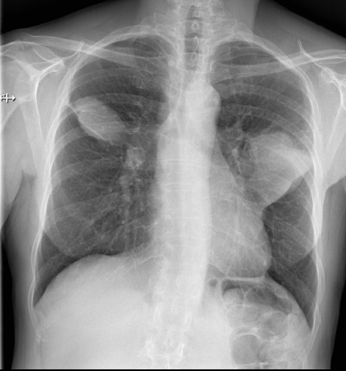 Dosimétrie en scanographie thoracique