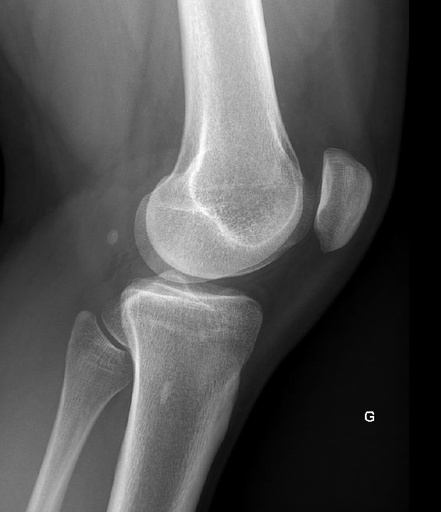 L'angle mort du genou 