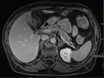 Lésions surrénaliennes