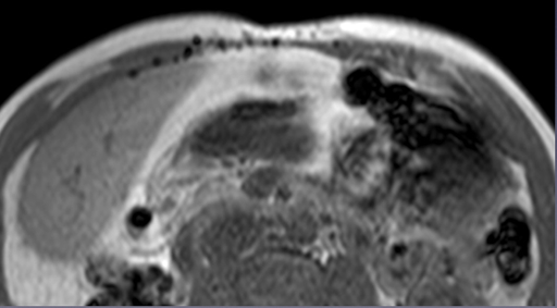 Post opératoire normal et pathologique