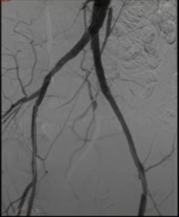 Comment réaliser une angioplastie ilio-fémorale ?