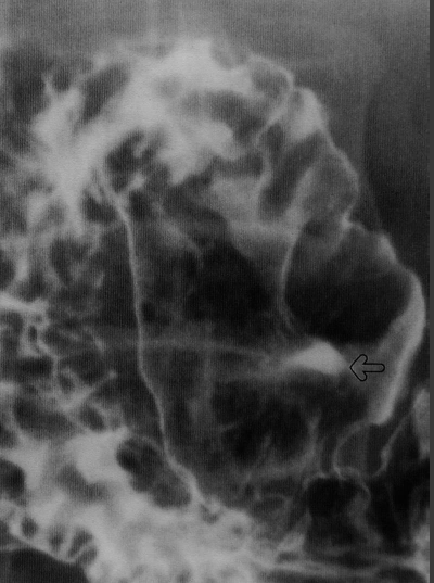 Pathologies bénignes du tube digestif