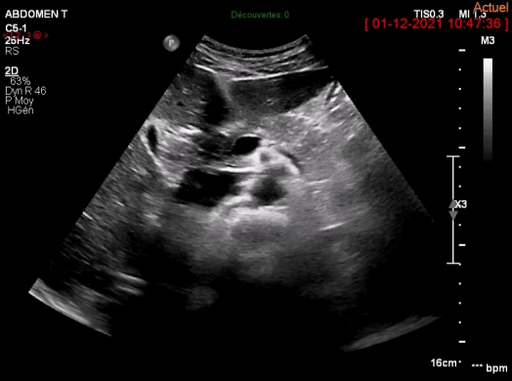 Echographie chez les candidats à la donation du lobe gauche du foie