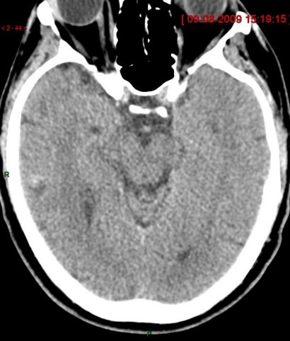 "Cachez ces anévrismes que je ne saurais voir"