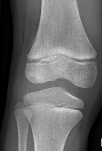 Imagerie du genou pédiatrique