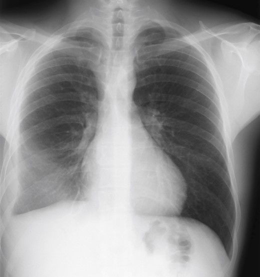 Imagerie du thorax
