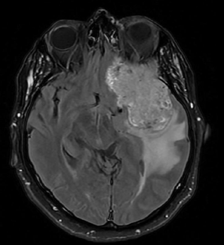 Unmasking cystic lesions 