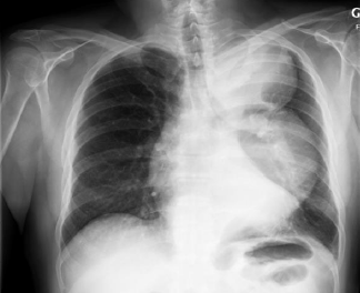 Pathologies médiastinales