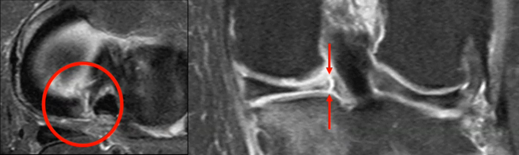 Genou  anatomie, lésions méniscales, arthrose typique atypique, SONK…